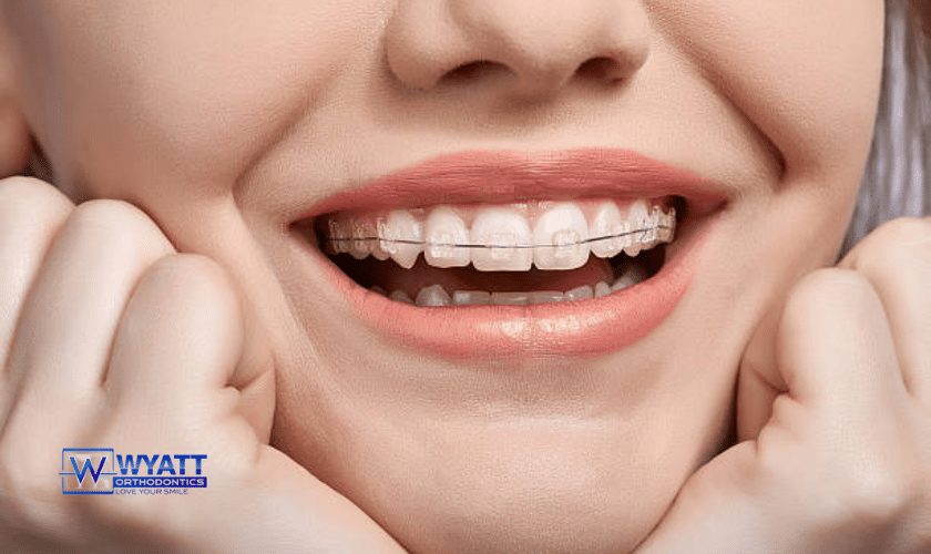 What are Ceramic Braces? How Do They Work?