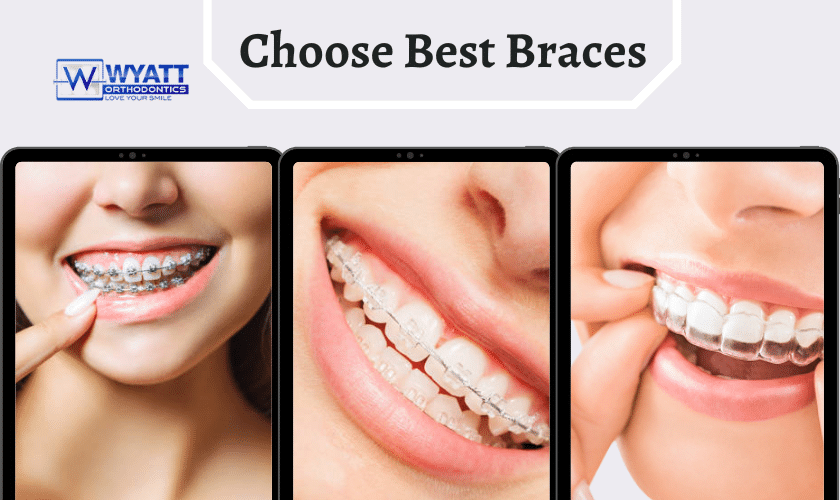 Best Choice In Braces That Matches Your Smile