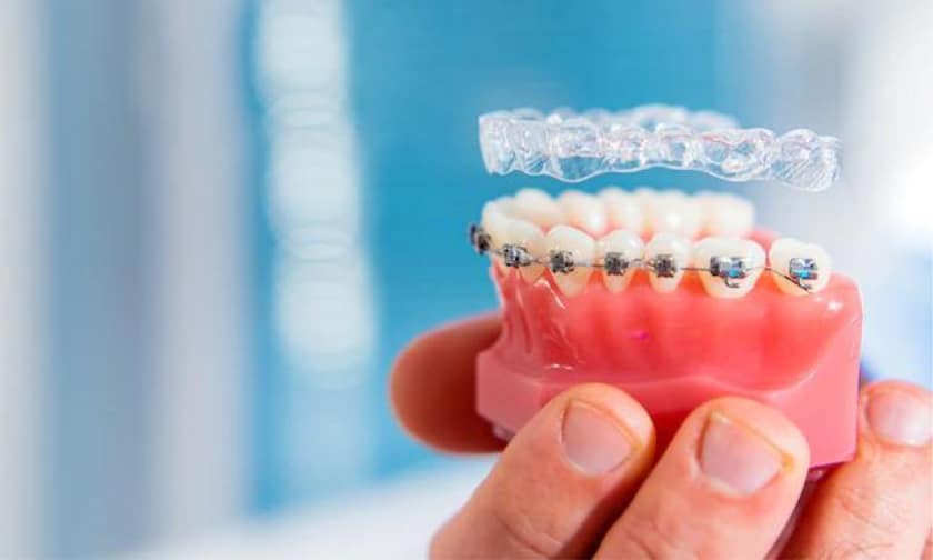 7 Things You Should Know Before Getting Braces