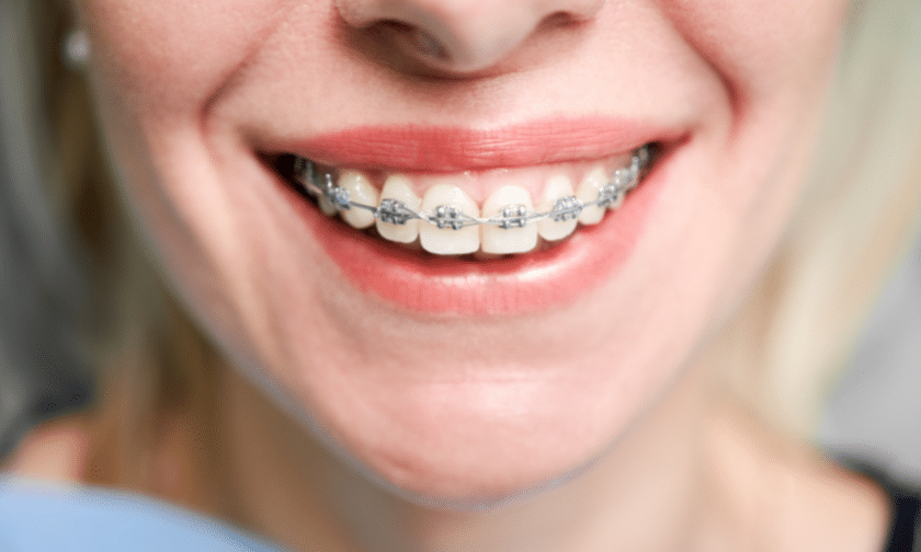 How Do Dental Braces Work?