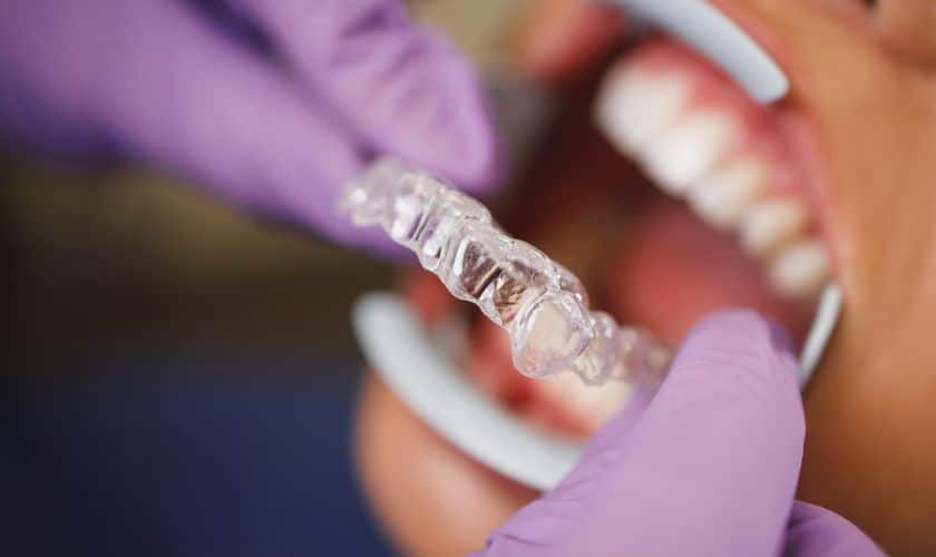 Invisalign: A Clear Solution For Crooked Teeth