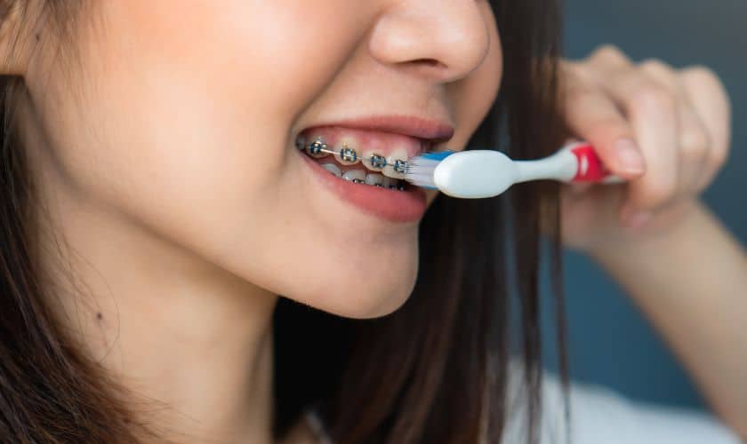 The Importance Of Good Oral Hygiene During Early Orthodontic Treatment