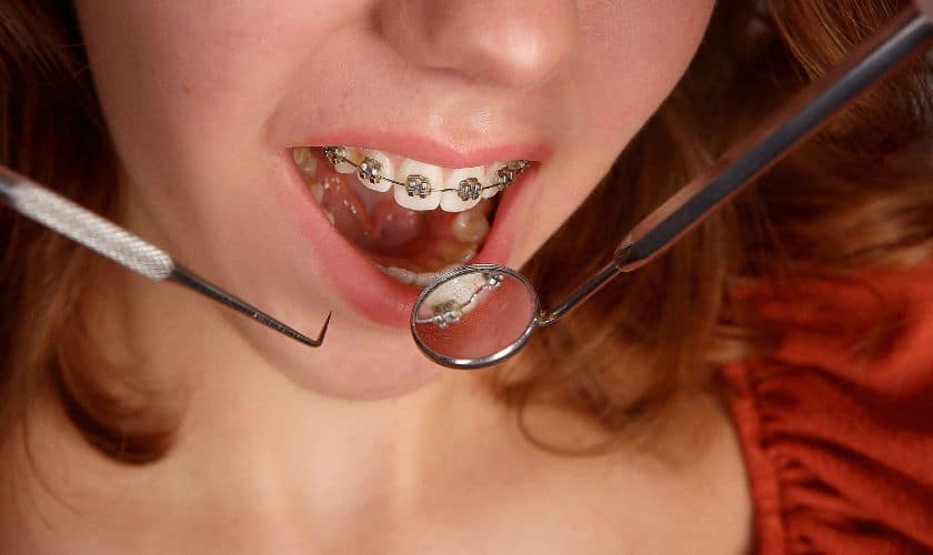 The Connection Between Surgical Orthodontics And Braces